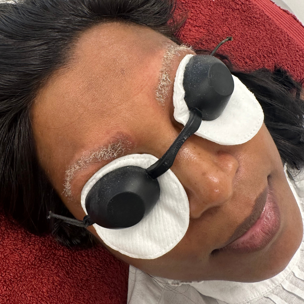pmu-laser-treatment